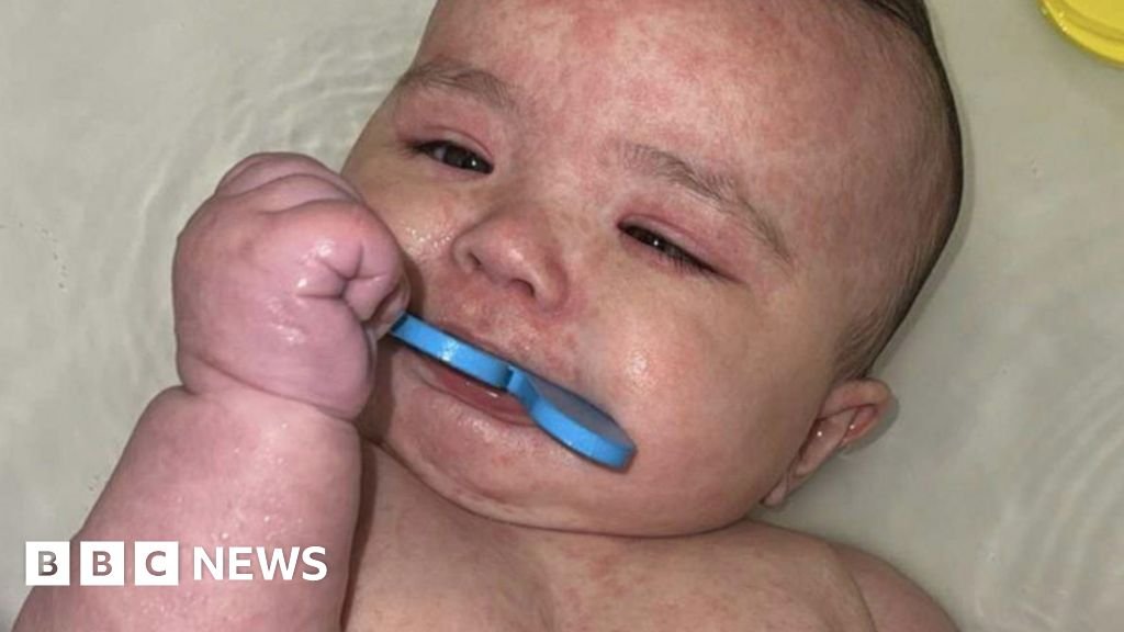 Como o Canadá se tornou o centro de um surto de sarampo na América do Norte